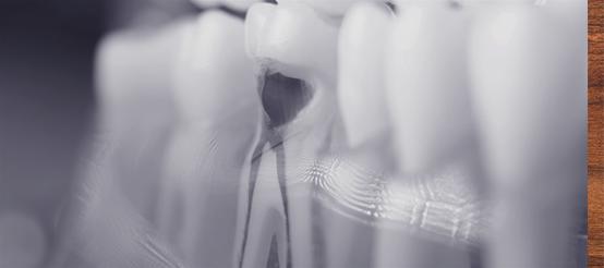 Root Canals & Crowns