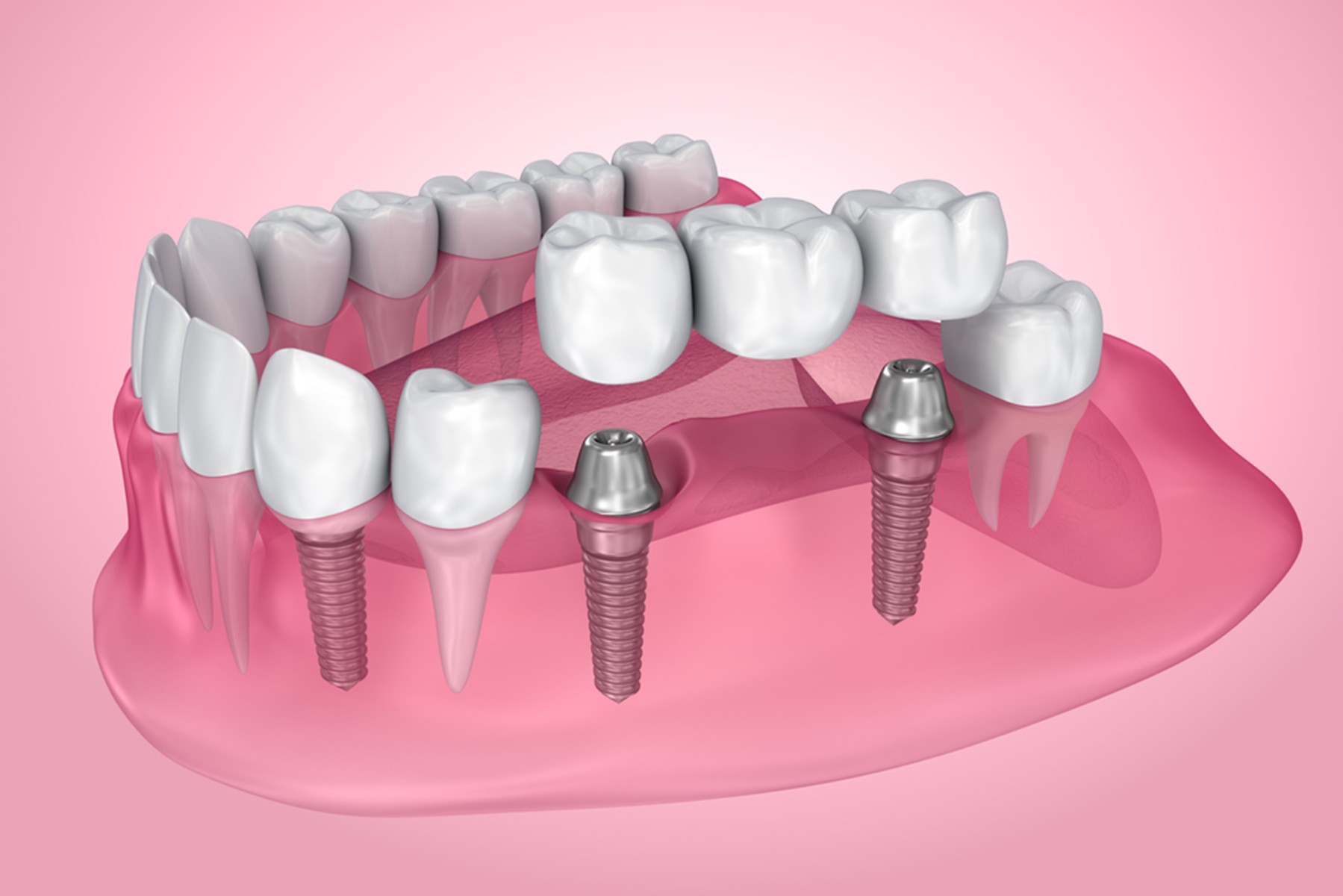 an introduction to dental implants