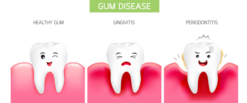 Healthy gums gingivitis periodontitis