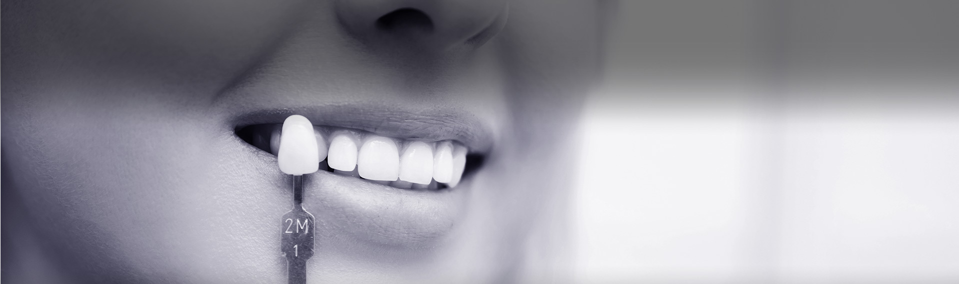 dental veneers in New Westminster