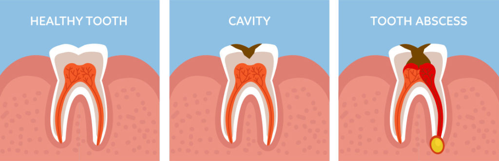 a diagram comparing a healthy tooth a cavity and a tooth abscess