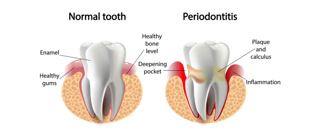 Happens when you don’t floss