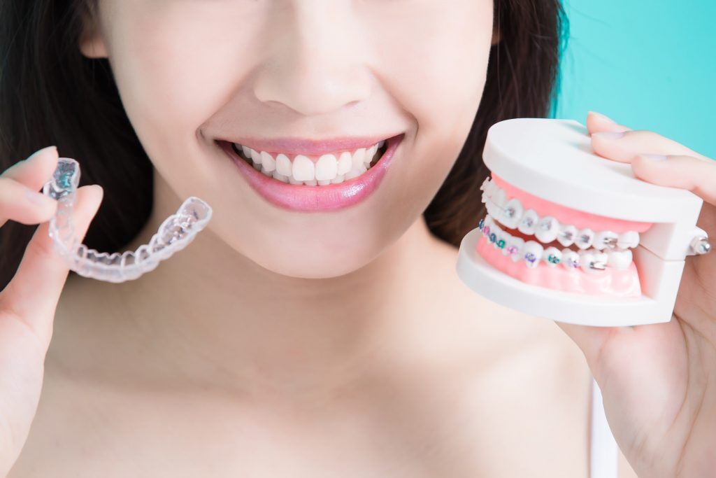 Invisalign is an ideal alternative to braces