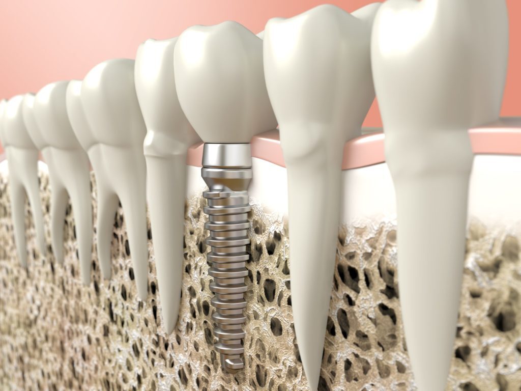Must You Always Get a Bone Graft Before Getting Dental Implants?