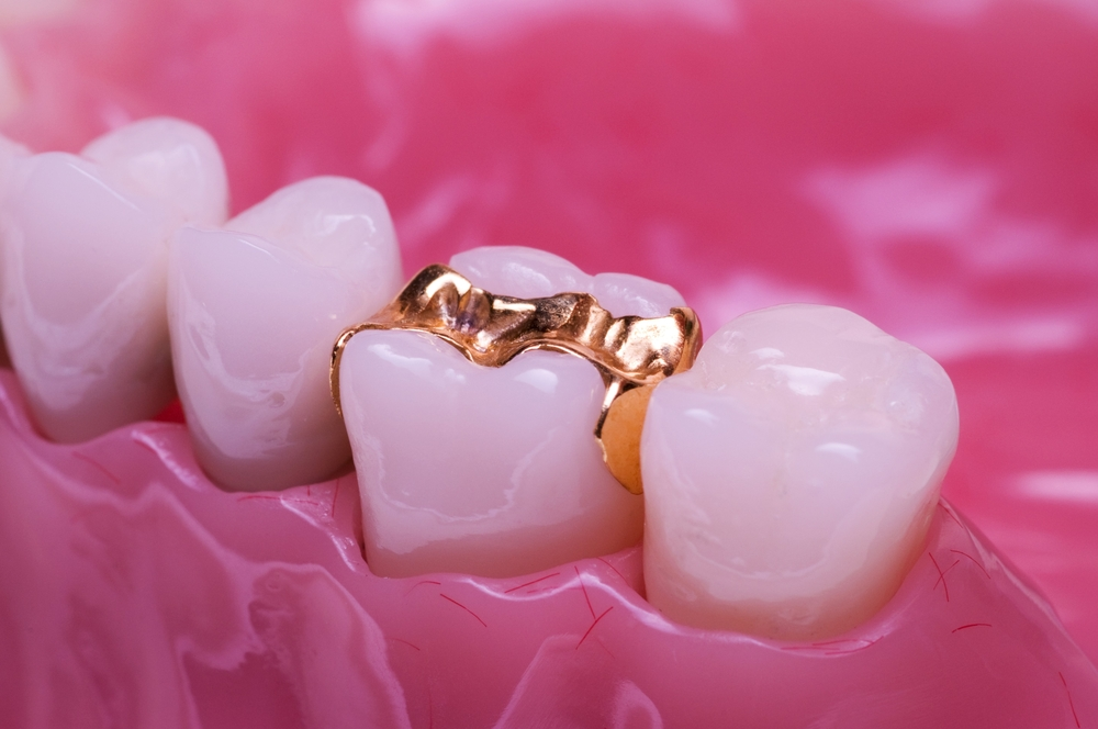 What are dental inlays