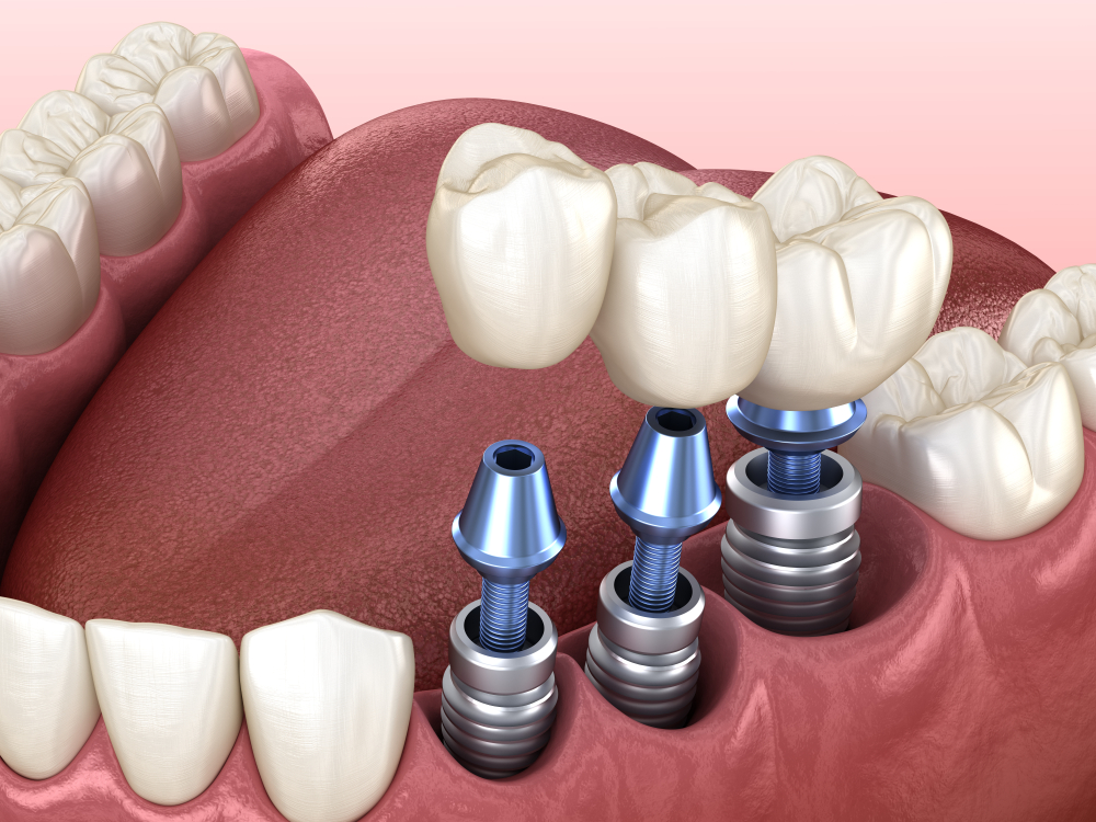 how long does a dental implant procedure take