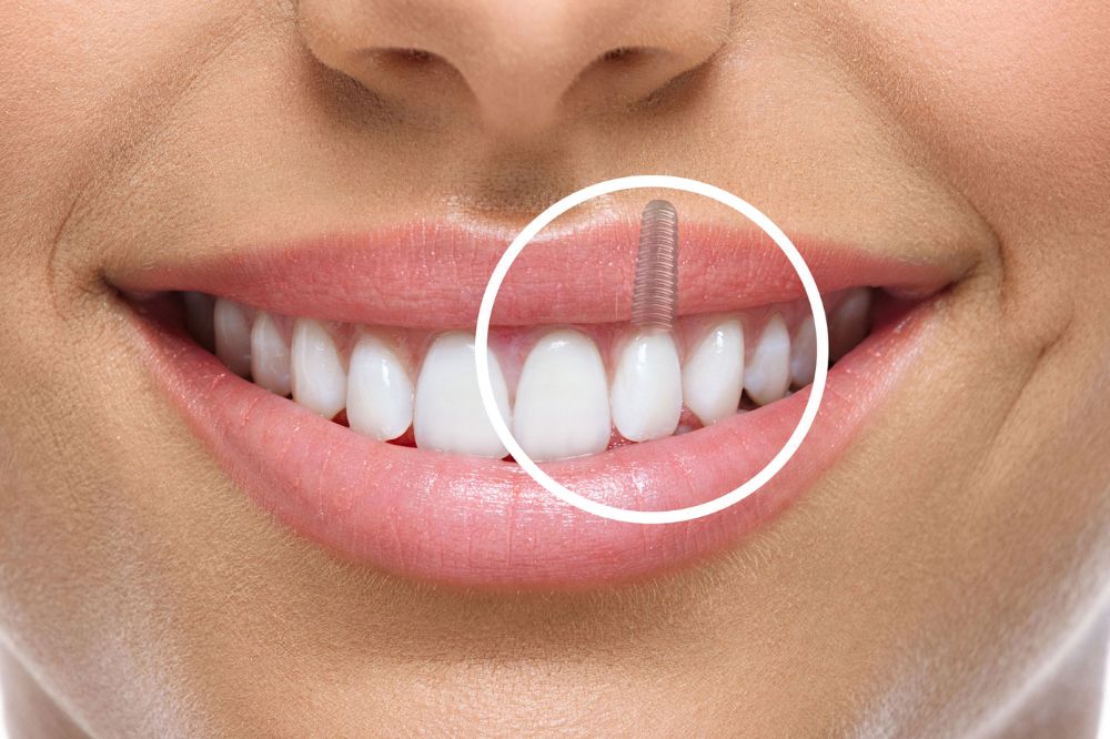 Are Dental Implants a Safe Option for Seniors?