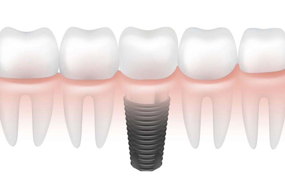 Looking to Replace Missing Teeth? Everything You Need to Know About Dental Implants in New Westminster