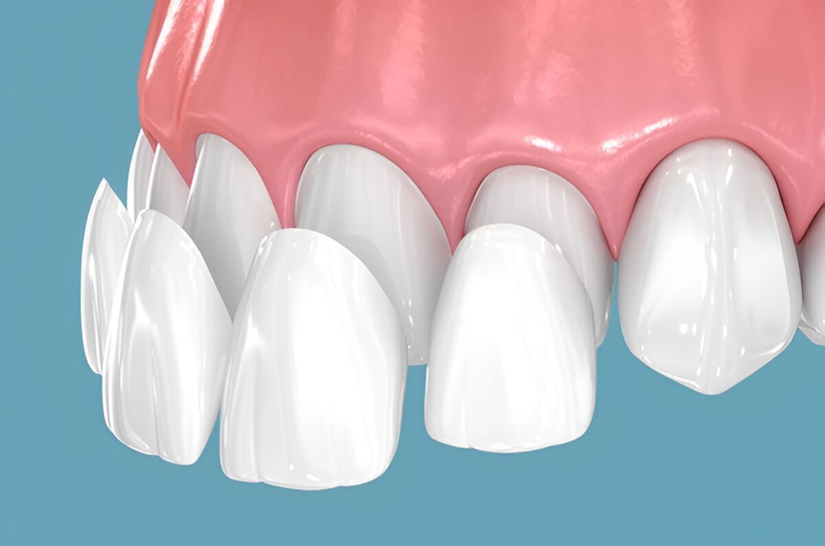 dental veneers in new westminster bc
