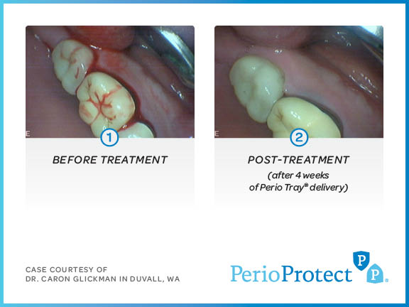 perio protect case studies10