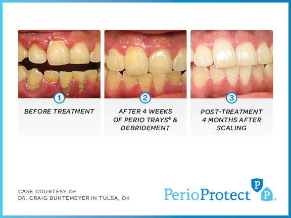 perio protect case studies11