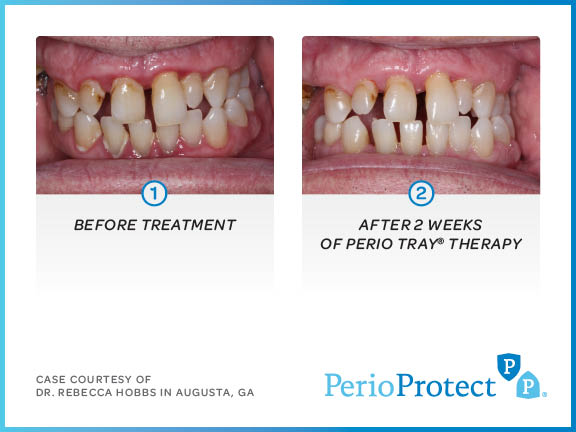 perio protect case studies4