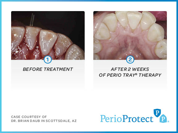 perio protect case studies5