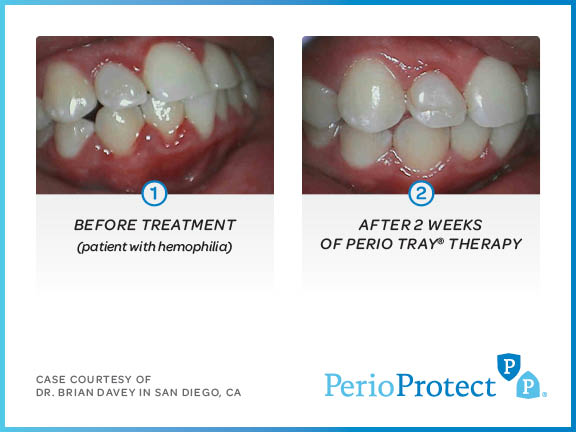 perio protect case studies8