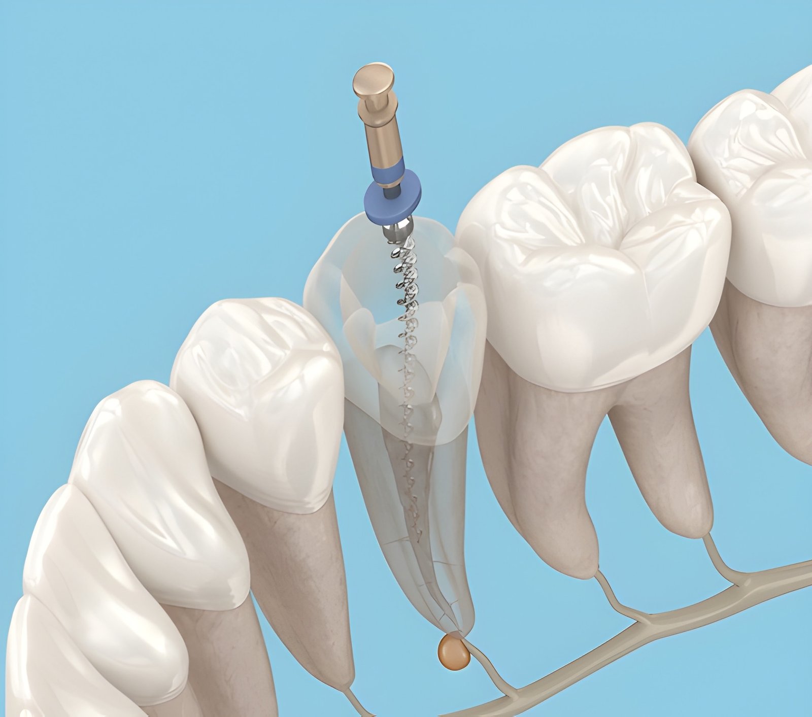 root canal therapy in new westminster bc