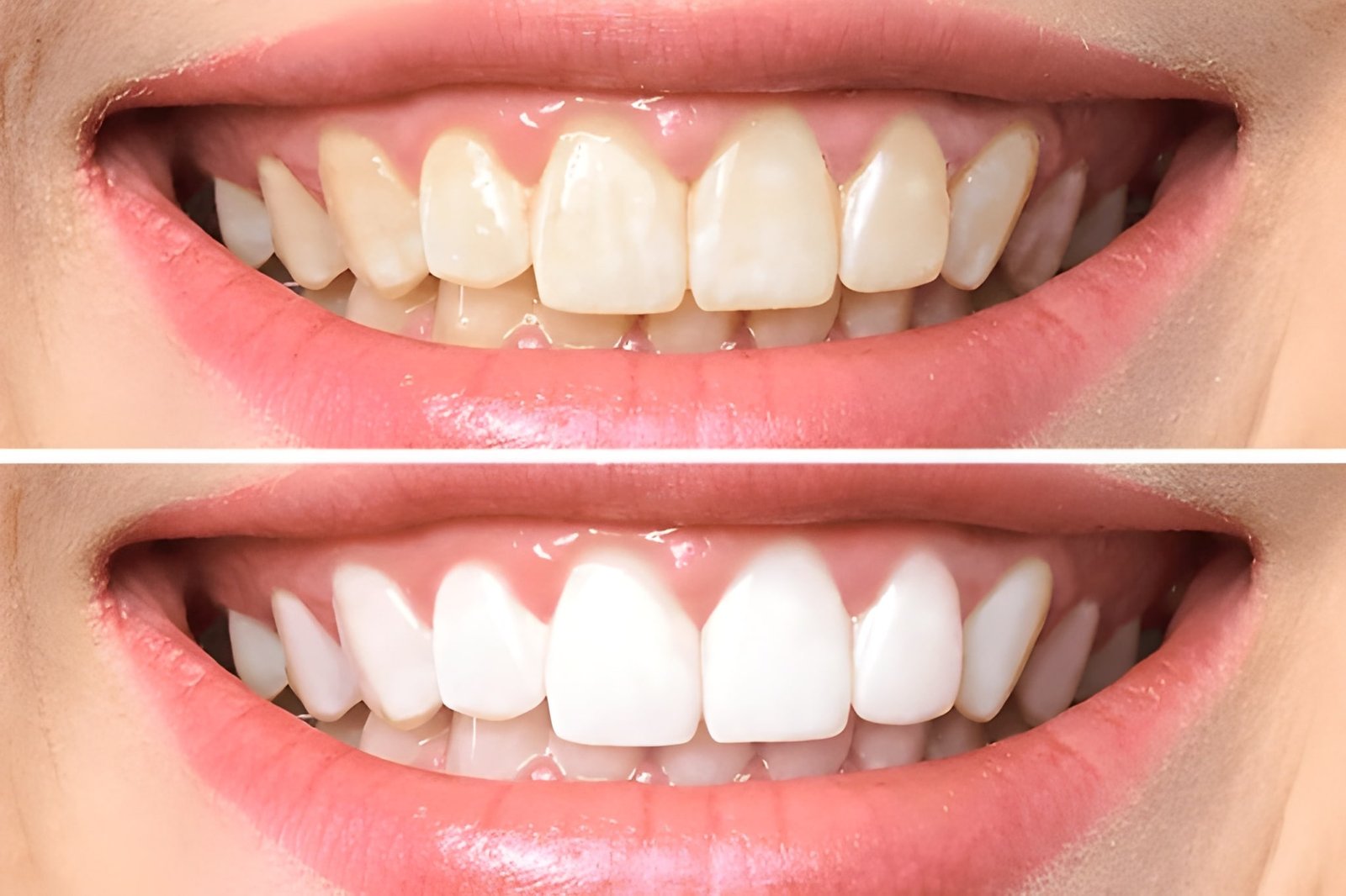 teeth whitening in new westminster bc